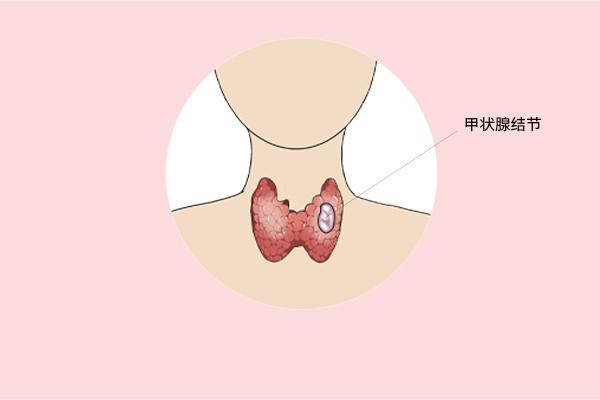 甲狀腺癌癥的主要癥狀表現(xiàn)有什么？為什么會得甲狀腺癌癥呢？