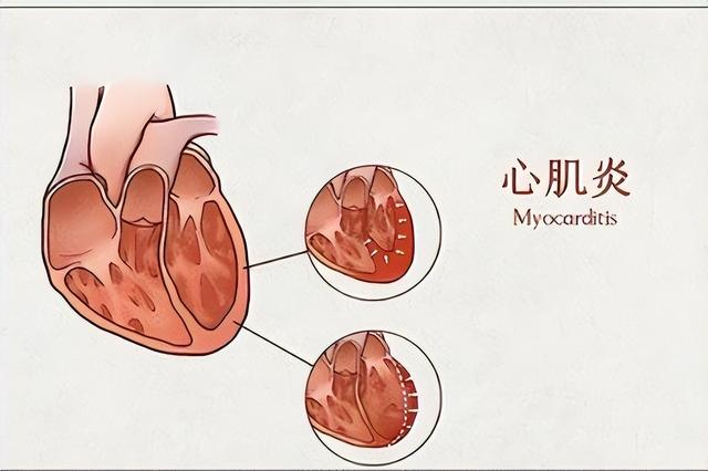 心肌炎的癥狀有哪些？心肌炎的主要變現(xiàn)癥狀有啥？